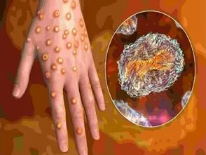 День ликвидации натуральной оспы!